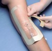 tegaderm 3m что это. Смотреть фото tegaderm 3m что это. Смотреть картинку tegaderm 3m что это. Картинка про tegaderm 3m что это. Фото tegaderm 3m что это