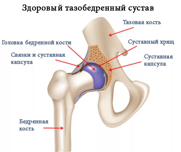 Врожденный вывих бедра