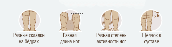 Врожденные вывихи и подвывихи бедра