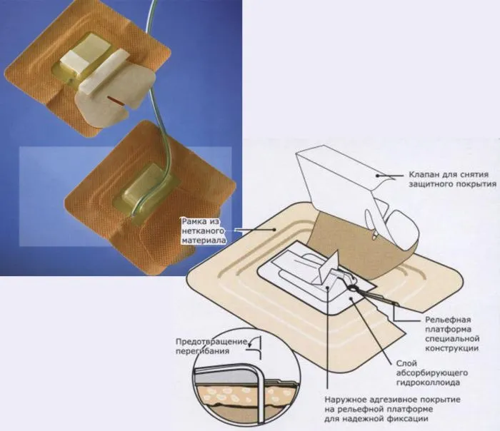 Повязка фиксирующая ConvaTec Drain-Fix, защитная, для дренажей, стерильная, водостойкая, 26х26 мм, 25 шт., 680M