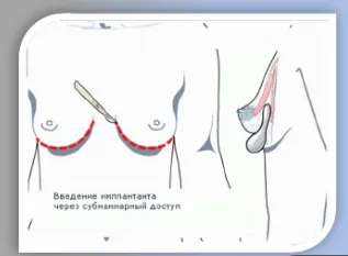 Пластырь силиконовый WinnerPlast (Виннер Пласт) для ухода за рубцами, форма Полумесяц, 1шт