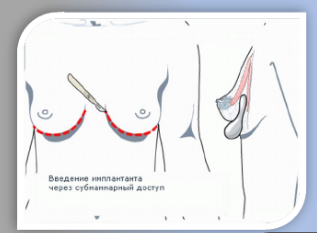 Пластырь силиконовый WinnerPlast (Виннер Пласт) для ухода за рубцами, форма Полумесяц, 1шт