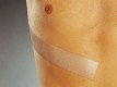Пластырь Mepiform (Мепиформ) силиконовый от рубцов самоклеящаяся, 10х18см, 293800