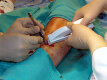 Степлер кожный хирургический Leukoclip SD, можно использовать до 100 раз, 5шт, 66047111