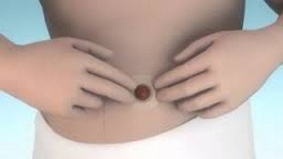 Кольцо защитное Колопласт / Coloplast Brava моделируемое, защита кожи от выделений, толщина 4,2 мм, уп. 30 шт, COL120425